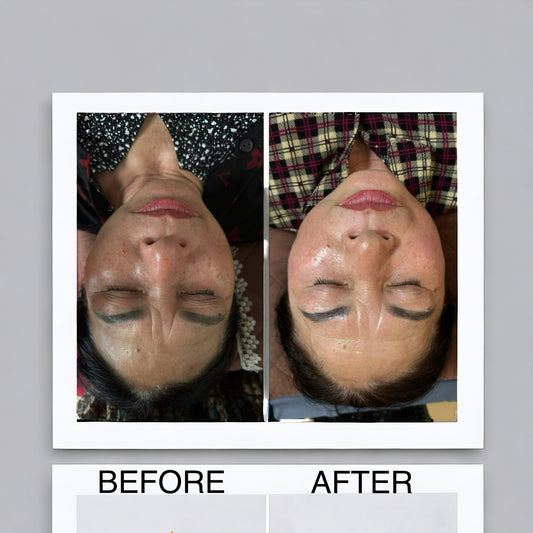 Hera Glass Skin Non-Peel Melasma Treatment